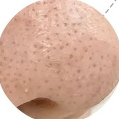 
Close-up of a nose with visible blackheads
