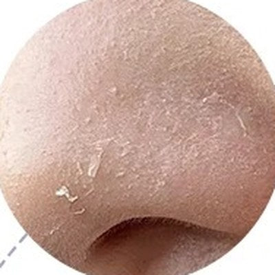 
Close-up of a nose with flaky dry skin
