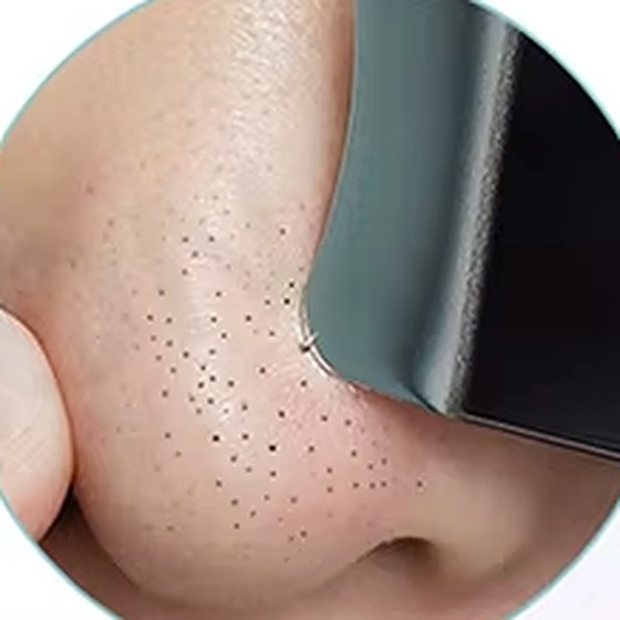
Close-up of a nose with visible blackheads